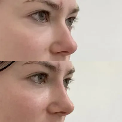 Skin Tightening, Botox and Lip Fillers by Skinsation LA
